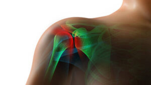 Analyzing the Rotator Cuff - 12 Chiropractic CE Hours