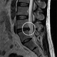 Treatments for Bulging & Herniated Discs - 2 Credit Hours