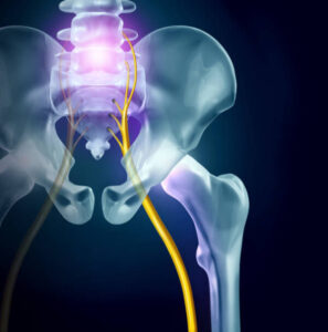 Understanding Piriformis Syndrome - 4 Chiropractic CE Hours