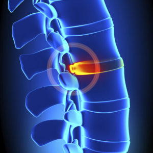 Chiropractic Guide to Disc Bulge & Herniation 2 Credit Hours